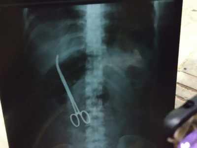 Bizarre: NIMS doctors forget scissor in woman's stomach after surgery