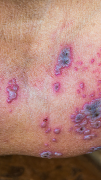 Skin Infections: Latest News, Videos and Photos of Skin Infections