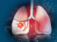 ​Detection of lung cancer at an <i class="tbold">early stage</i> is important​