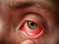 ​​What is <i class="tbold">conjunctivitis</i>?​