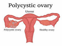 ​<i class="tbold">polycystic ovary syndrome</i> (PCOS)​