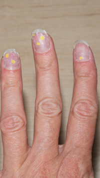​Yellow spots on nails can signal towards these 10 health issues