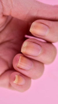 ​​Yellow nail syndrome​