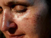 ​​Why does pigmentation occur?​