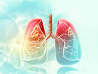 ​The importance of early detection: A game-changer in lung <i class="tbold">cancer treatment</i>​