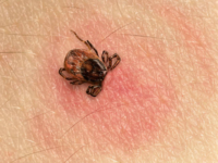 ​What does a skin rash due to <i class="tbold">lyme disease</i> look like?​