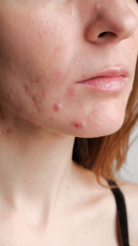 ​10 tips to treat <i class="tbold">hormonal</i> acne
