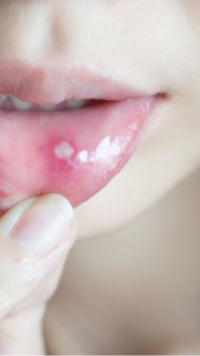 Inflammation in mouth