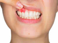 Receding gums and its symptoms