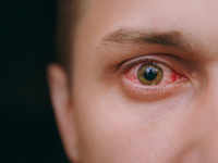 ​You can get dark circles and <i class="tbold">bloodshot</i> eyes