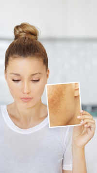 Home remedies to get rid of dark spots