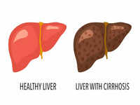 ​More about cirrhosis of the liver