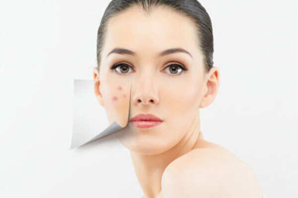Adult acne: Causes and treatments