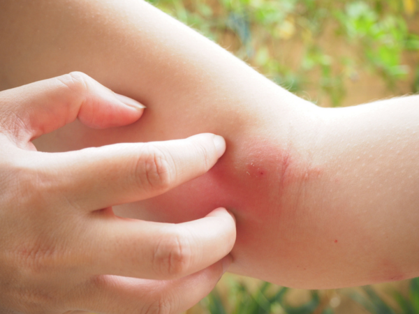 Woke up with a skin lesion? Blame it on printer insect!