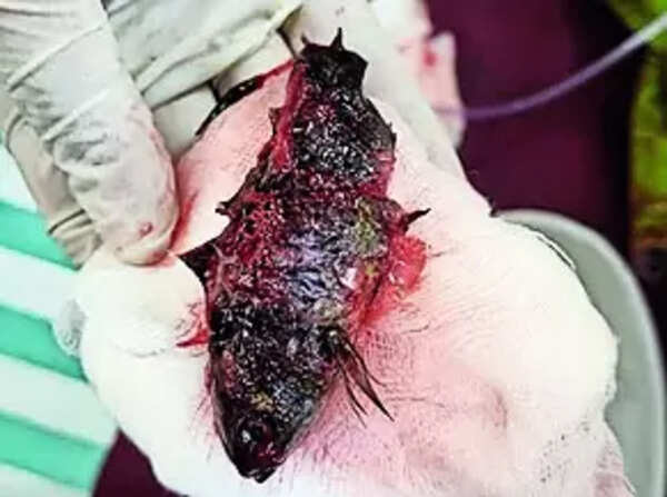 Doctors remove 11cm fish stuck in 11-month-old boy's throat in Karnataka