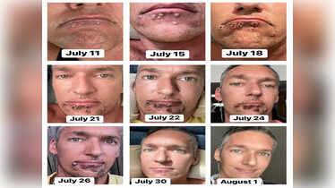Monkeypox infection: Gay porn actor shares pictures of skin ...