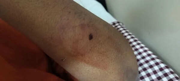 Census worker, NMC staff among 3 bitten by dog in Sadar