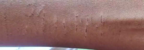 Chhattisgarh shocker: Mass wrist-cutting by 35 schoolkids, probe flags ‘imitation' trend; Counsellors on job