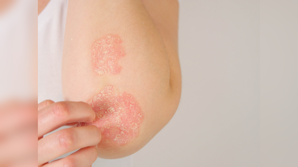 Vitamin D deficiency? Look for these 5 signs on your skin