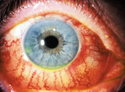 Don’t ignore that red eye, it can be a case of more than just conjunctivitis