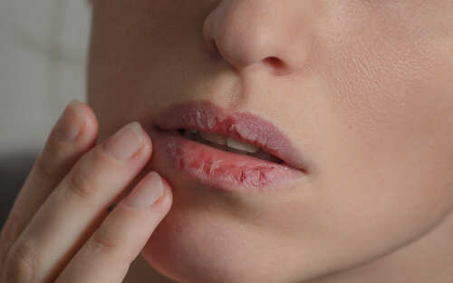 semaglutide chapped lips Chapped Lips: From Anaemia to diabetes: Your chapped lips might be a sign  of a serious health condition