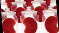 Hyderabad: MBA grad sells own kidney, becomes agent for donors and dupes many 