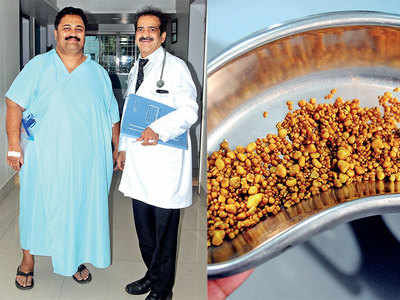 Pune: Over 1,450 stones extracted from bizman’s gall bladder