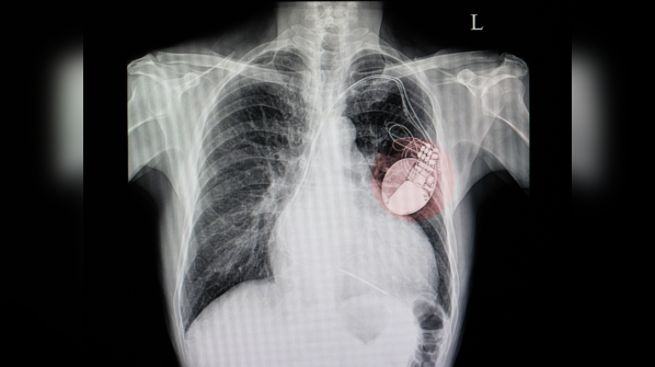 Irregular Heartbeats Can Cause These Health Risk irregular-heartbeats-can-cause-these-health-risk