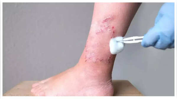 Poor Wound Healing