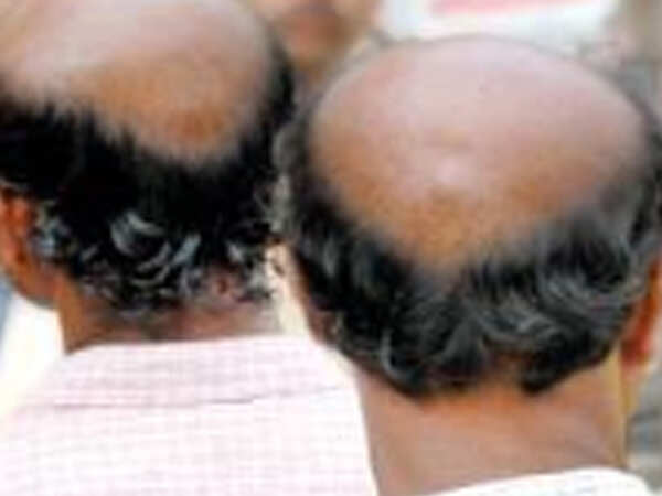 Hair now & gone the next? Here’s the bald truth