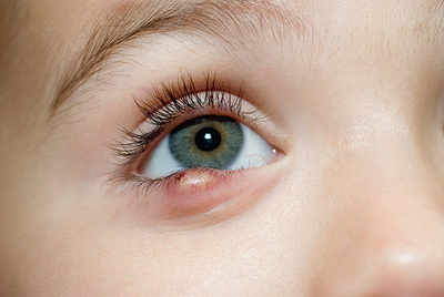 Eye infections on the rise in city