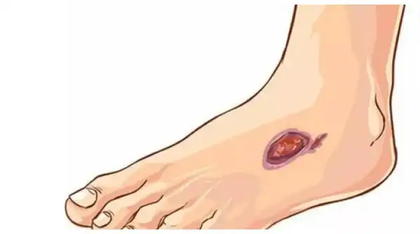 Non Healing Sores