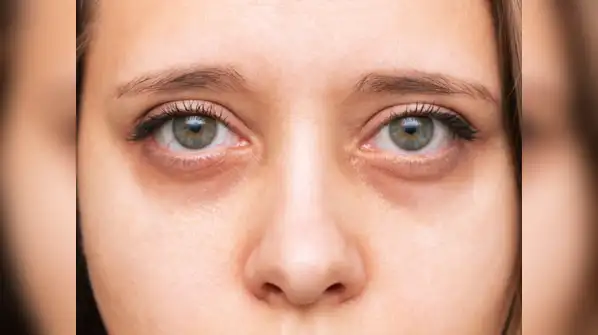 Sunken eyes