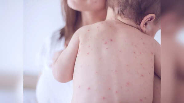 Monkeypox risk for kids: As more cases in kids are reported, here's ...