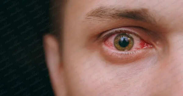 Ludhiana witnesses rise in eye flu cases in summer