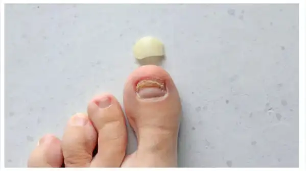Nail Lifting