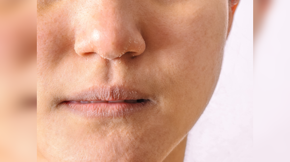 Dry skin