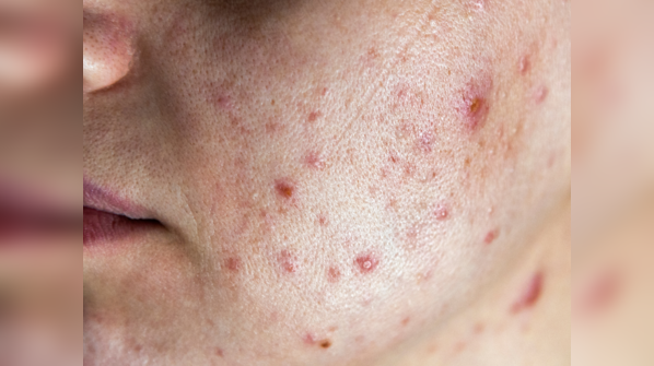 Acne as an adult