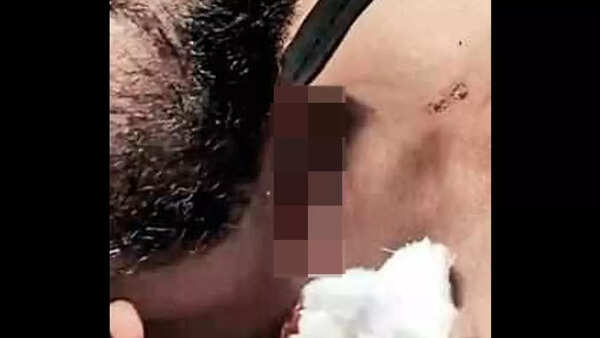 Hyderabad: Man injured after banned Chinese manja slits neck
