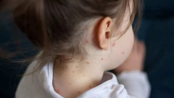 Measles case reported in Palamu