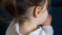Measles case reported in Palamu