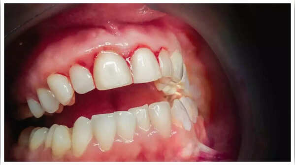 Gum Disease (Gingivitis)