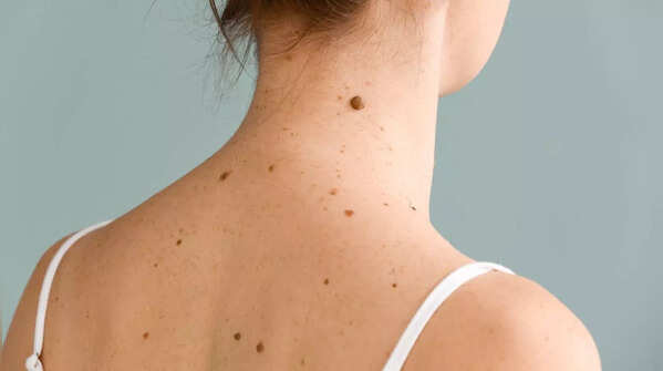 Watch out for new moles, growths or bumps on your skin