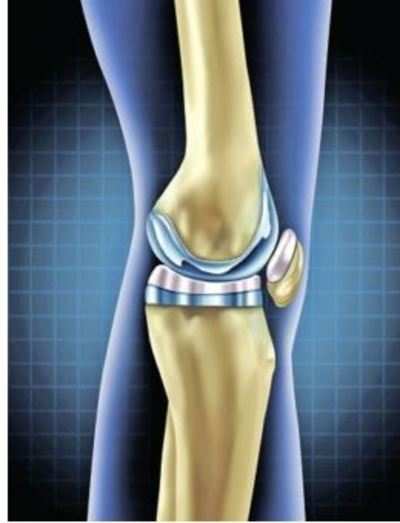 ​ Knee implant prices capped, to cost 65% less