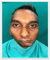 After decades, Raipur man regains jaw movement following complex surgery
