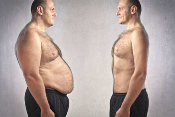 Bariatric surgery: Things you must know