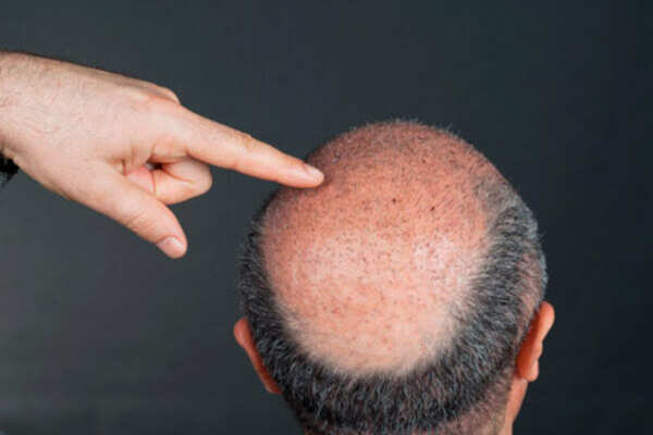 All about hair transplant procedures