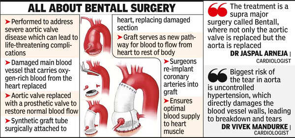 Docs Perform Complex High Risk Bentall Surgery On Five Patients Docs Perform Complex High Risk Bentall Surgery On Five Patients
