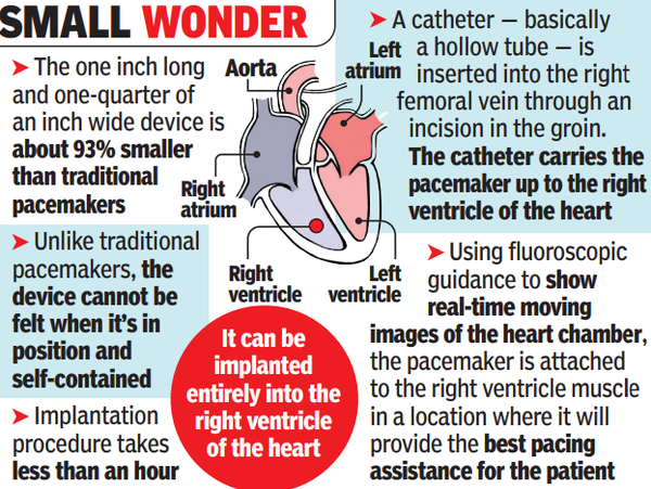 In a 1st, ‘smallest’ pacemaker implanted at AIIMS Bhopal
