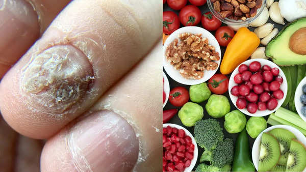 Foods that fight fungal infections hotsell